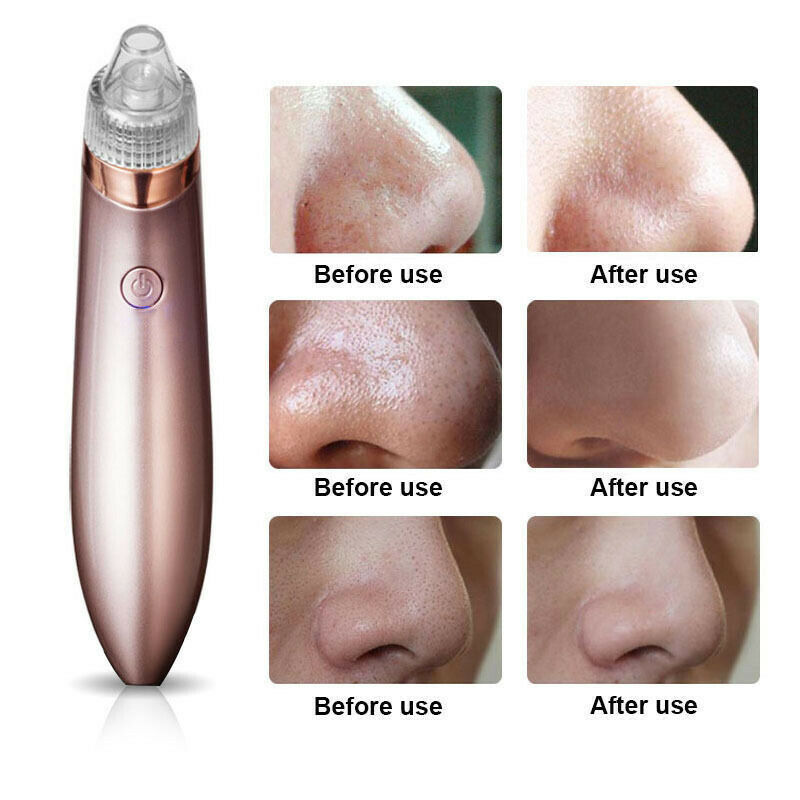 LINTROVA™ Electric Blackhead Remover & Pore Vacuum Cleaner