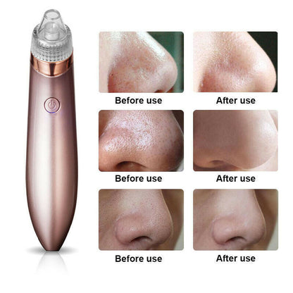 LINTROVA™ Electric Blackhead Remover & Pore Vacuum Cleaner